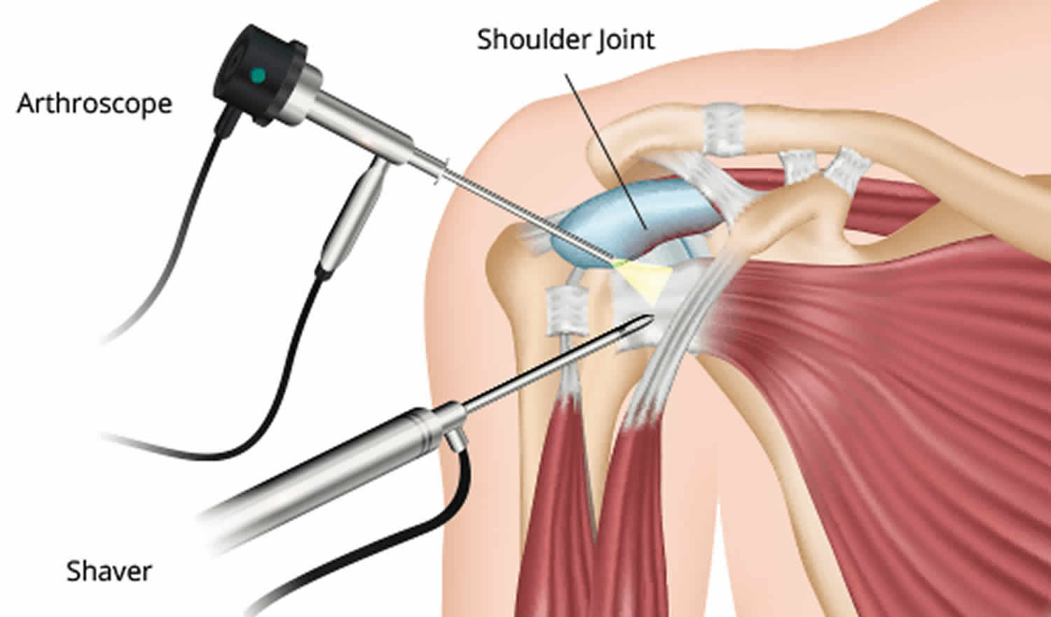 Arthroscopy