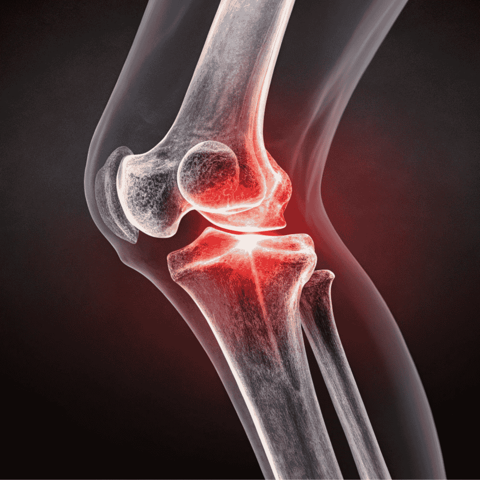 Bone and Joint Infection Management