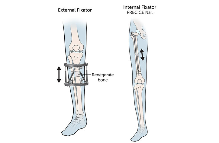 Limb Lengthening