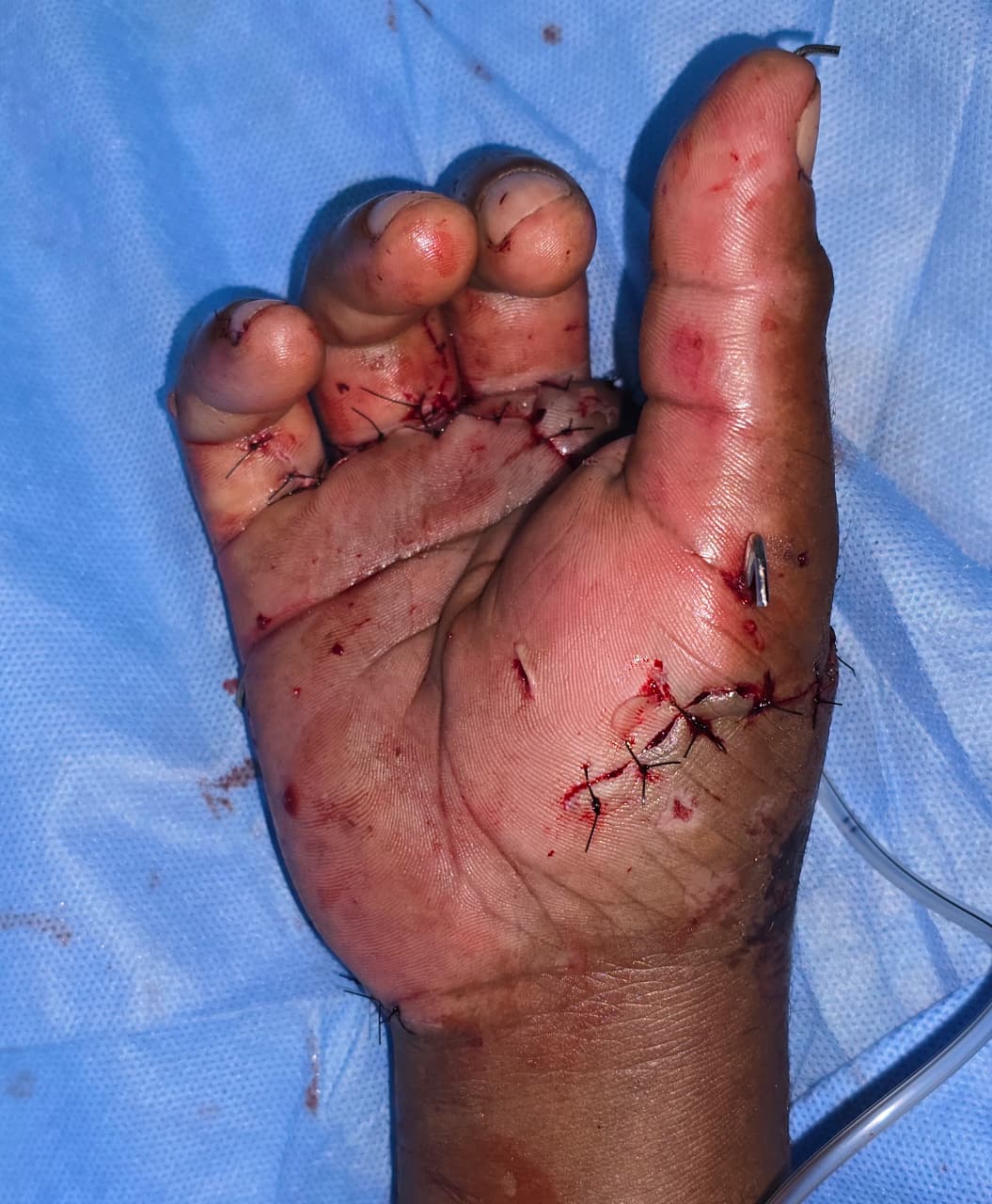 After Critical Right Hand Injury