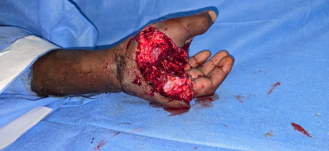 Before Critical Right Hand Injury