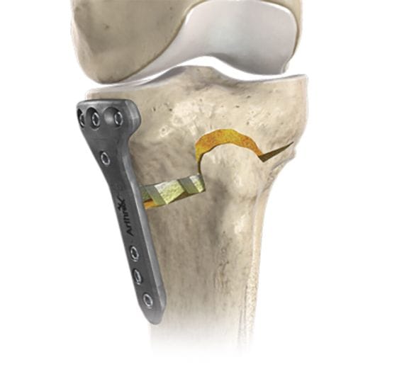 Joint Preservation - HTO