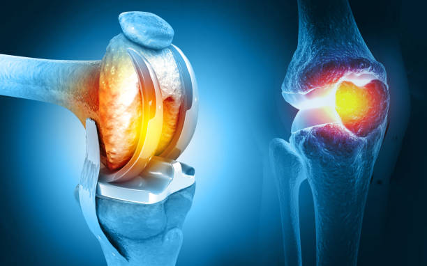 Total Knee Replacement